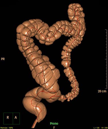 La colonscopia virtuale in 3D