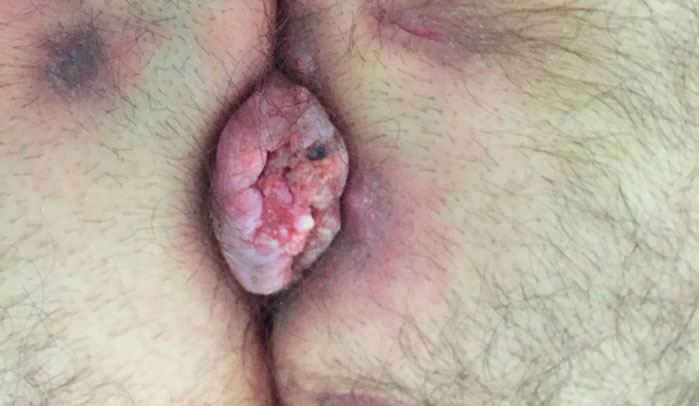 Una cisti sacrococcigea con complicanze