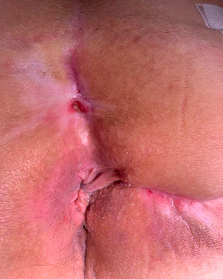Fistola perianale